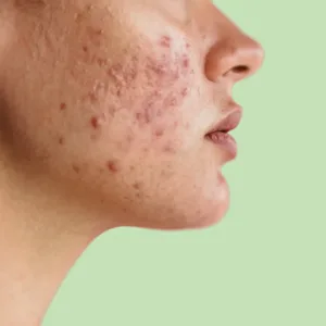 Acne